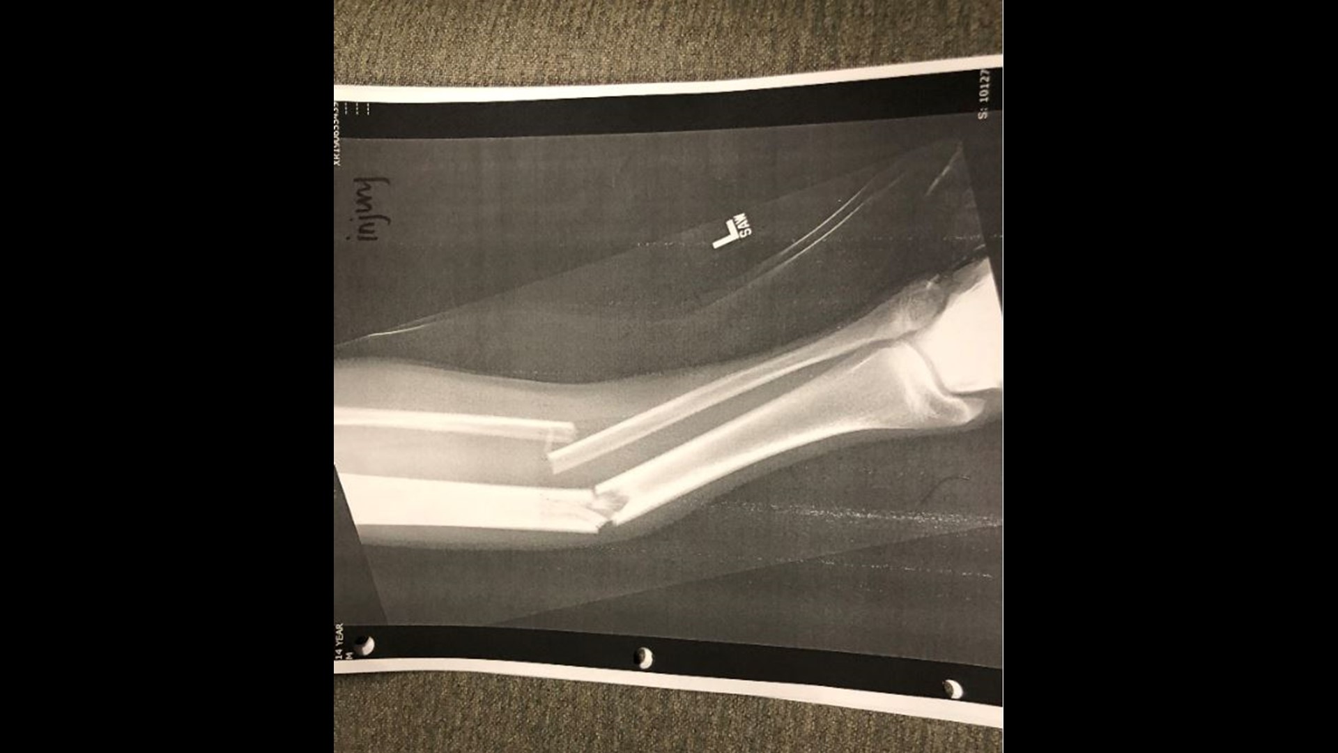 Trampolinerelated injuries, broken bones continue to rise