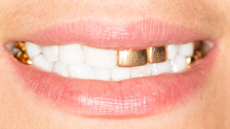 Almost $160,000 in missing dental gold leads to charges for IU dental worker in Indianapolis