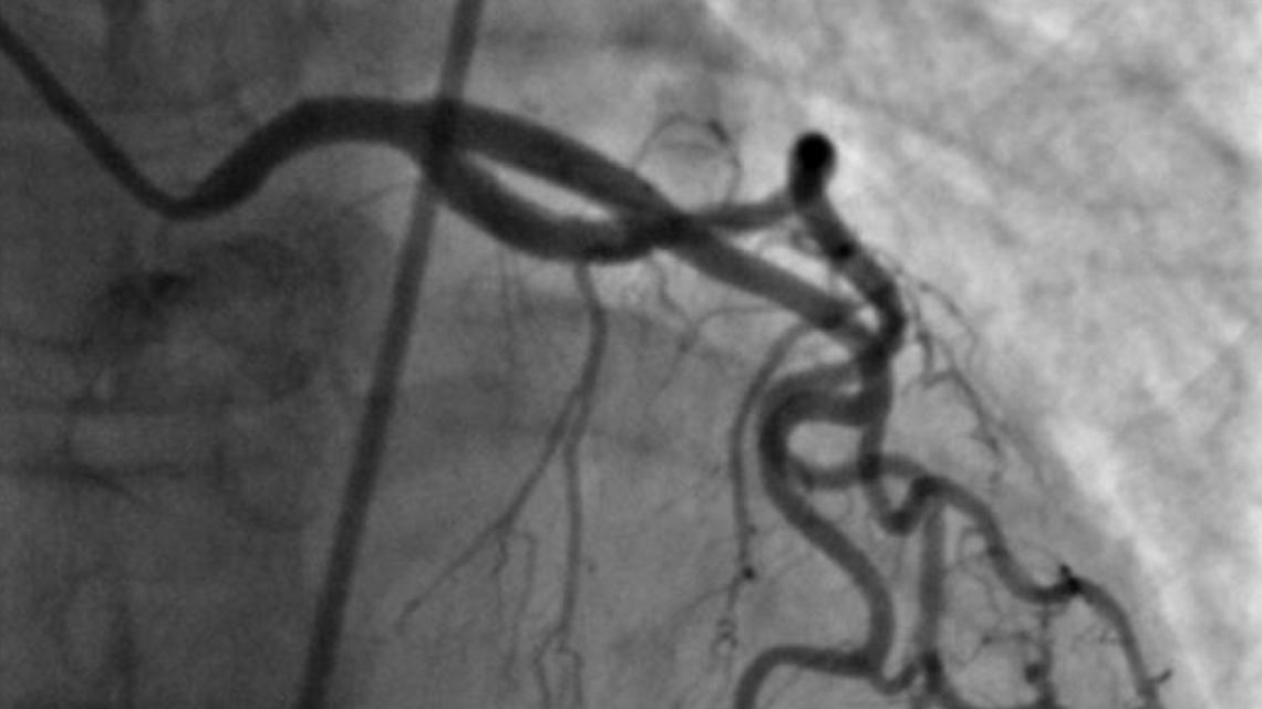 Heart Broken: Patients claim Indiana heart doctor subjected them to unnecessary cardiac procedures - Vimarsana News