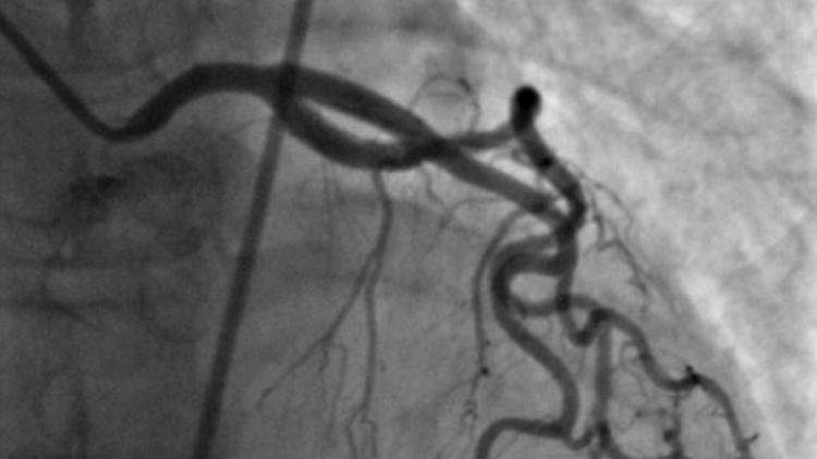 Heart Broken: Patients claim Indiana heart doctor subjected them to unnecessary cardiac procedures
