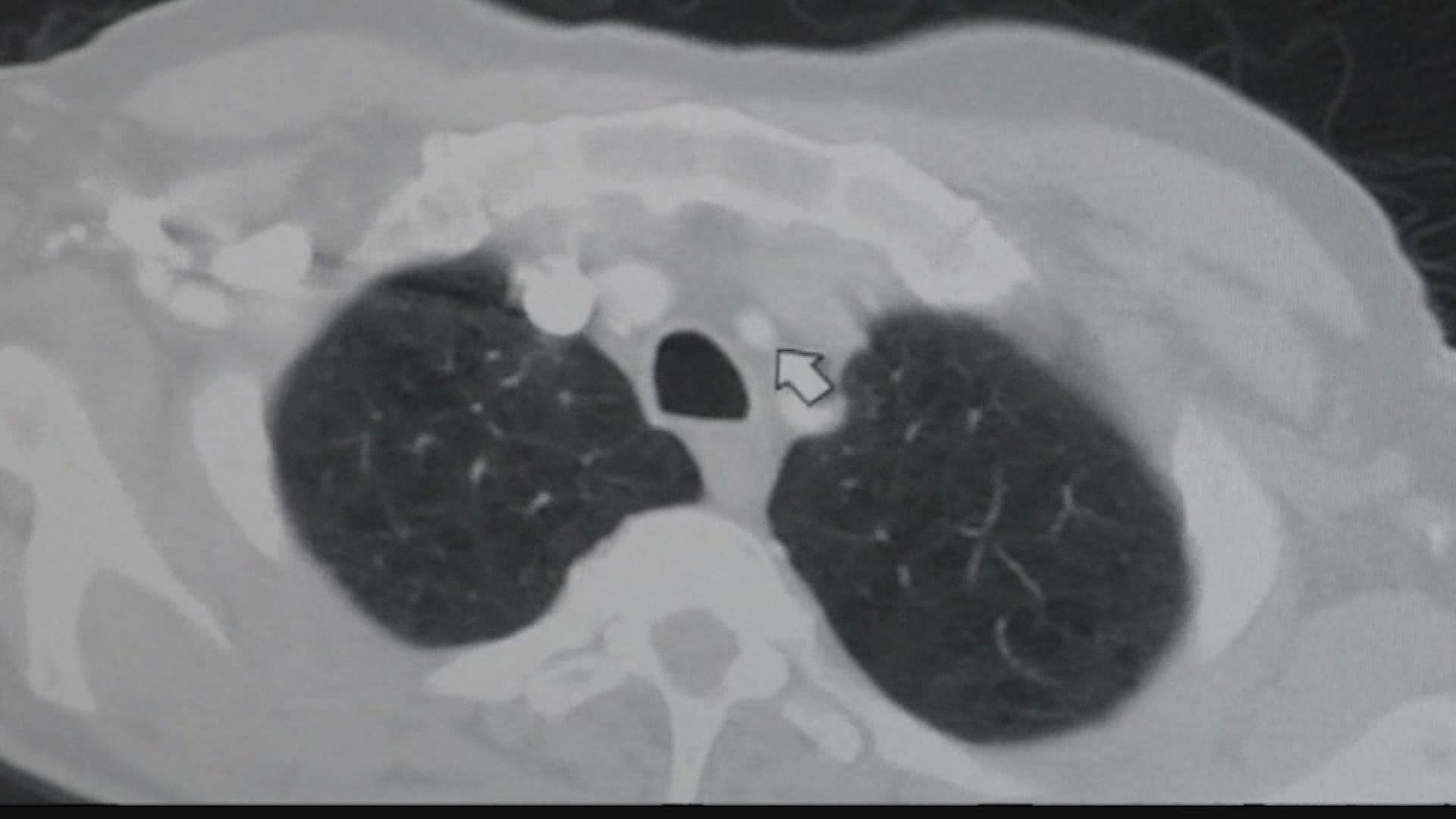 Early screening can detect lung cancer before a patient shows any symptoms.