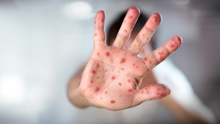 Indiana’s measles outbreak ends as US case count climbs slightly