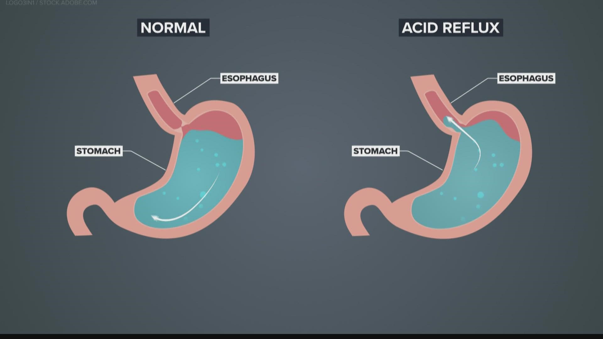 While your stomach has a protective lining, the esophagus does not. This can become painful, and over time, dangerous.