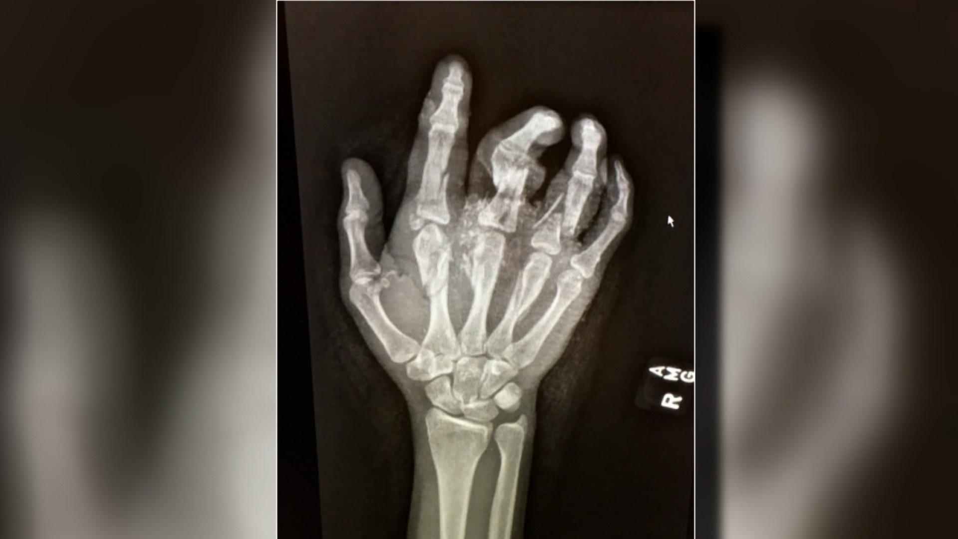 Elwood pitcher better than ever after losing finger in accident