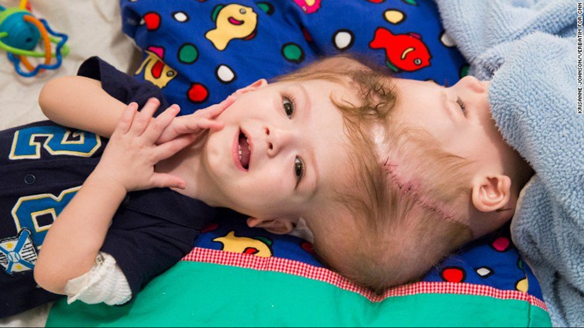Conjoined Twins Separated One Twin Now Out Of Surgery