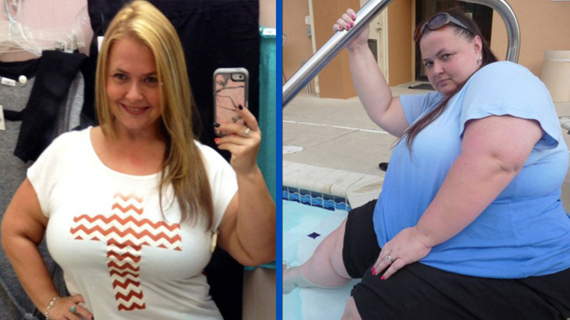 Woman Shares Reality of 150lb Weight Loss With Permanent Deep