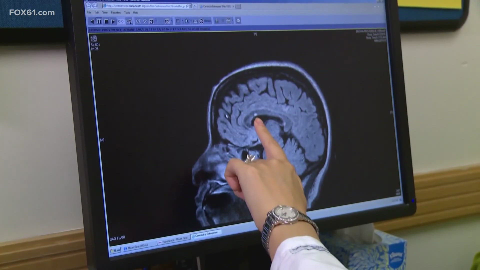 A new study found MS may begin much earlier than previously recognized.