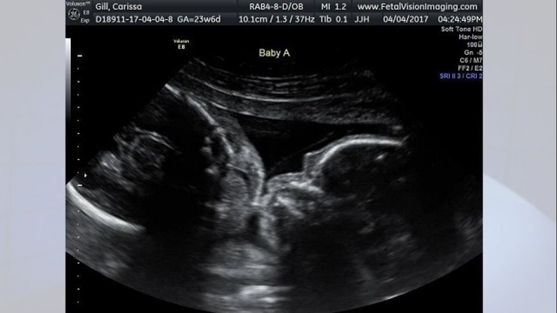 Ultrasound Shows Twins Kissing In Mother S Womb Fox61 Com