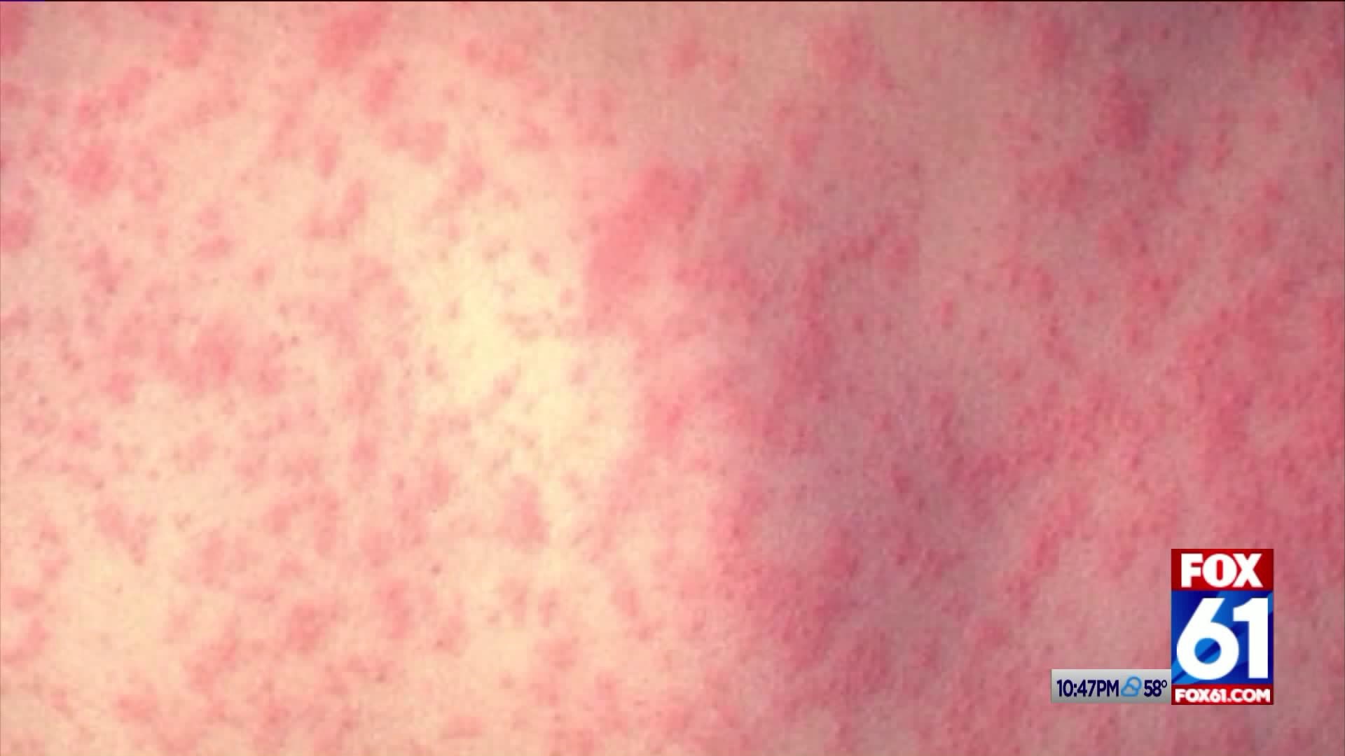 Just how likely is a Measles outbreak in Connecticut?