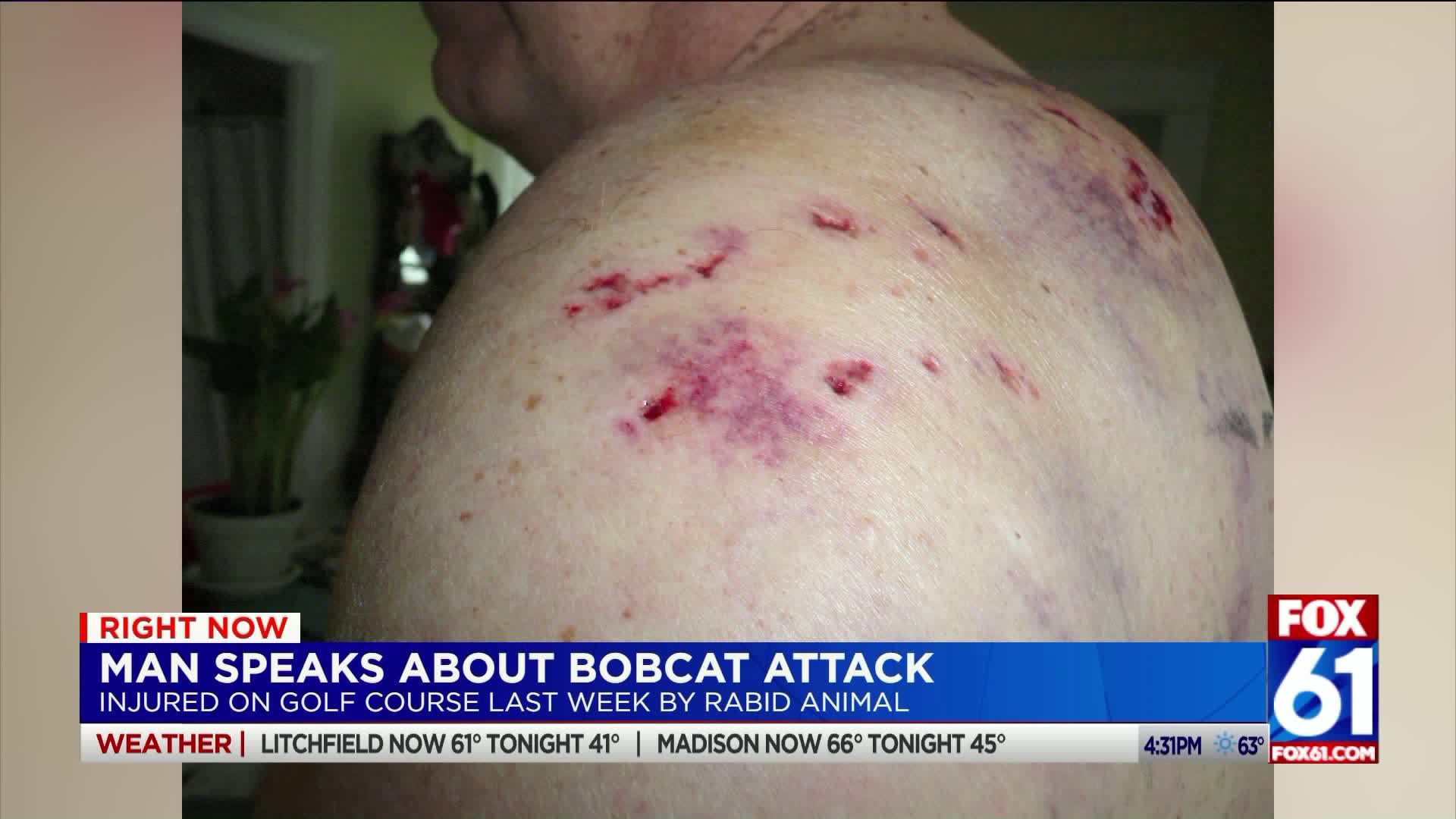 Man speaks out about bobcat attack