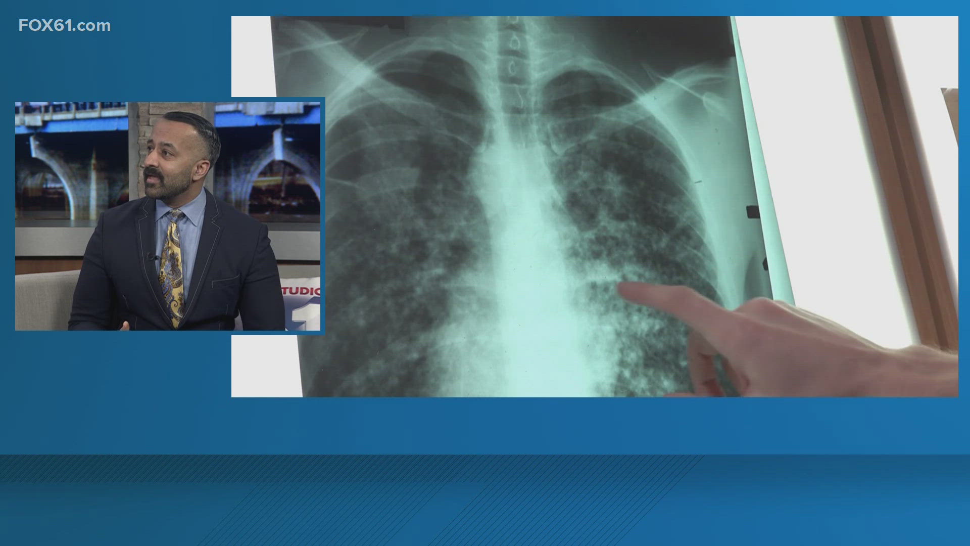 Dr. Syed Hussain from Trinity Health of New England has the latest health news.