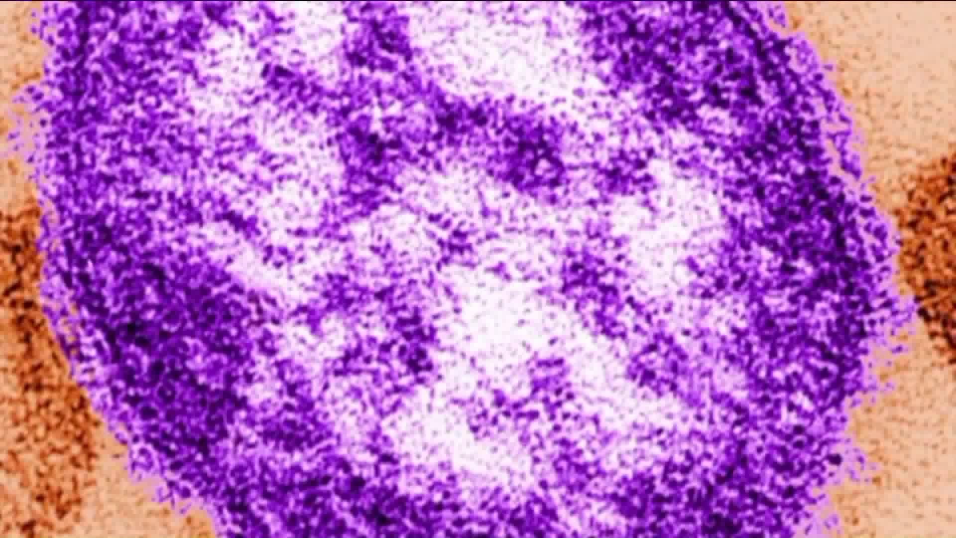 2nd case of measles confirmed by Yale-New Haven Hospital
