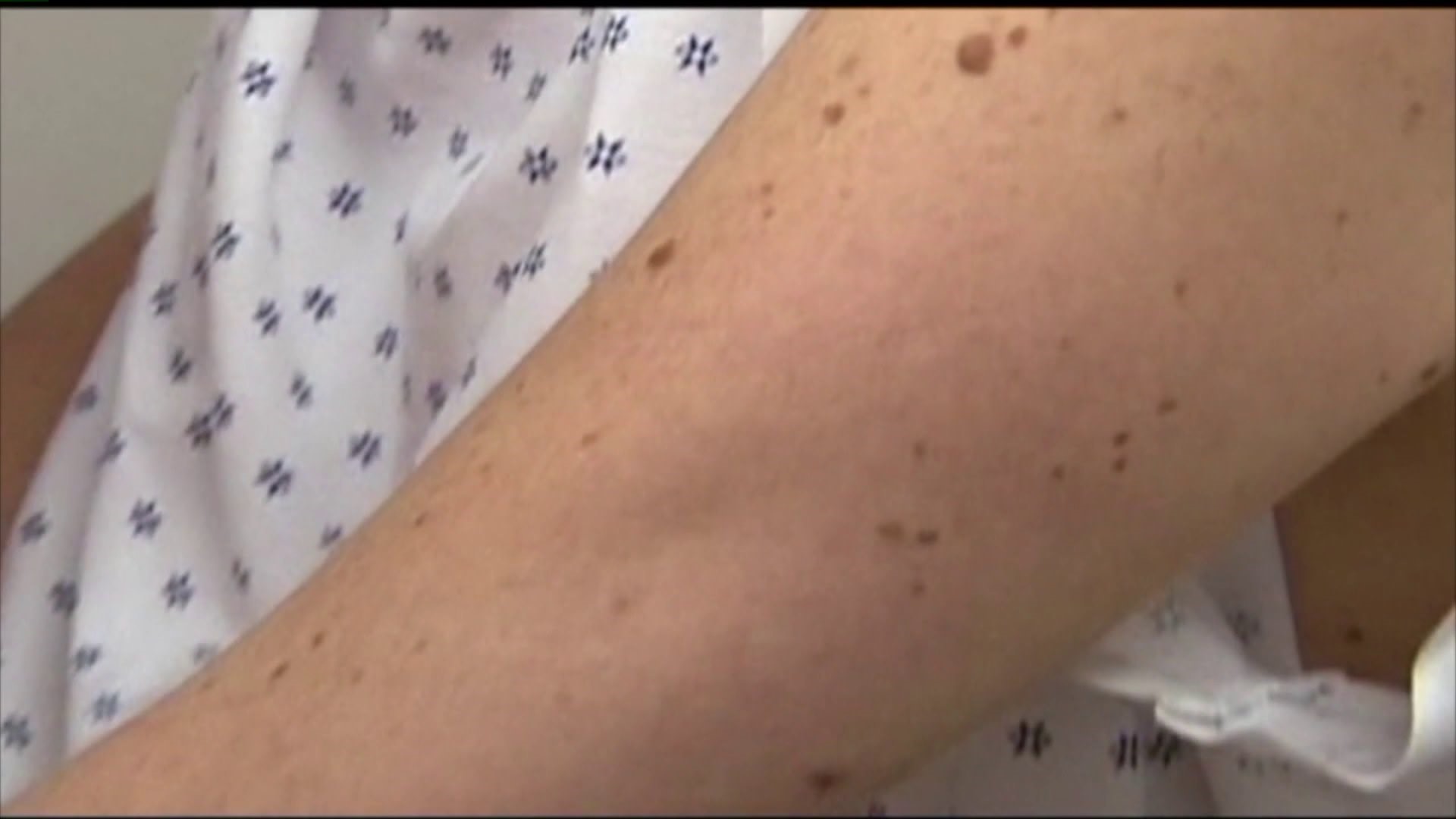Detecting skin cancer