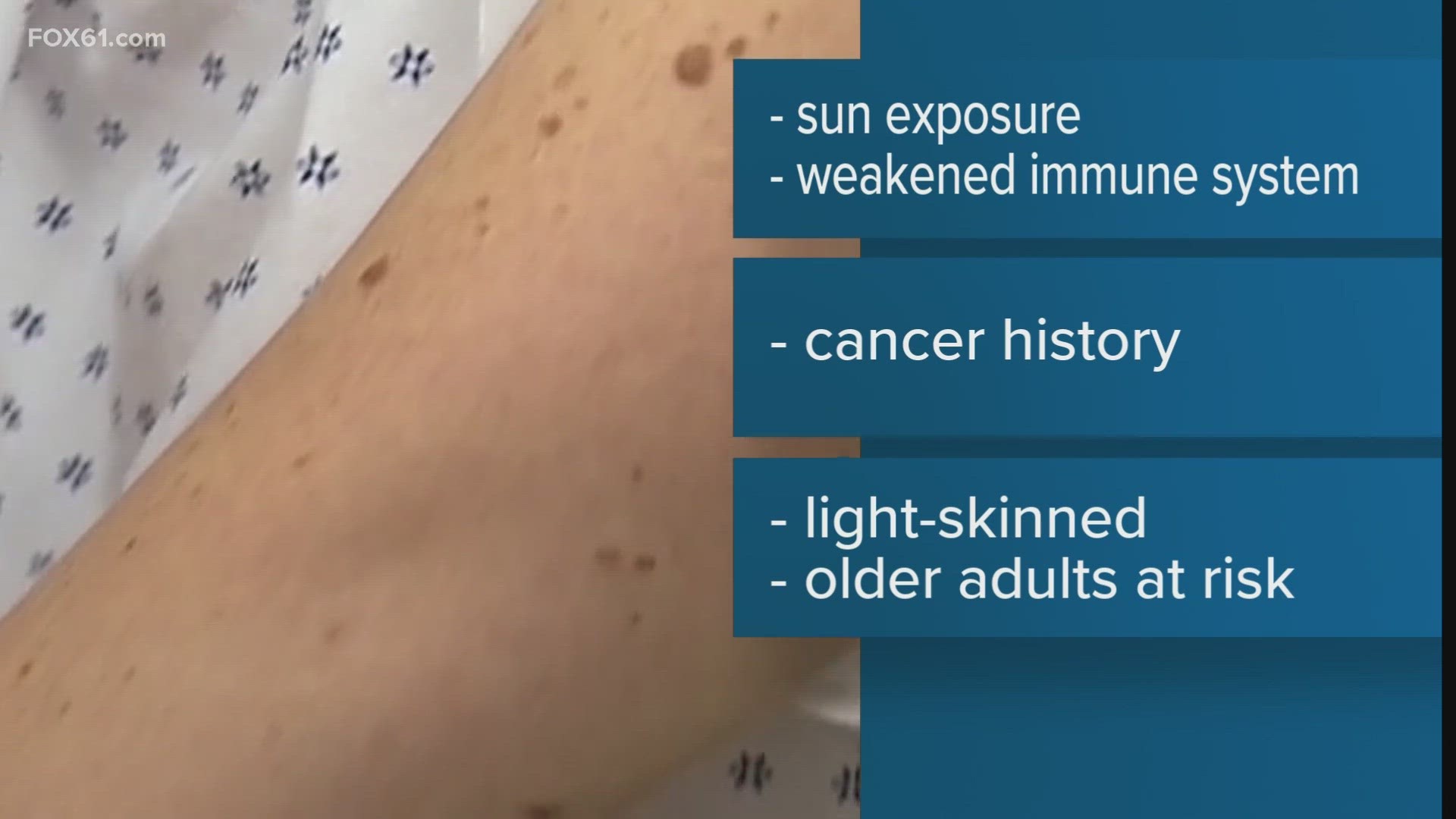 Dr. Andrew Salner, Dir. of 'Helen & Harry Gray Cancer Center' at Hartford Hospital, discusses the rare skin cancer that caused Jimmy Buffett's death.