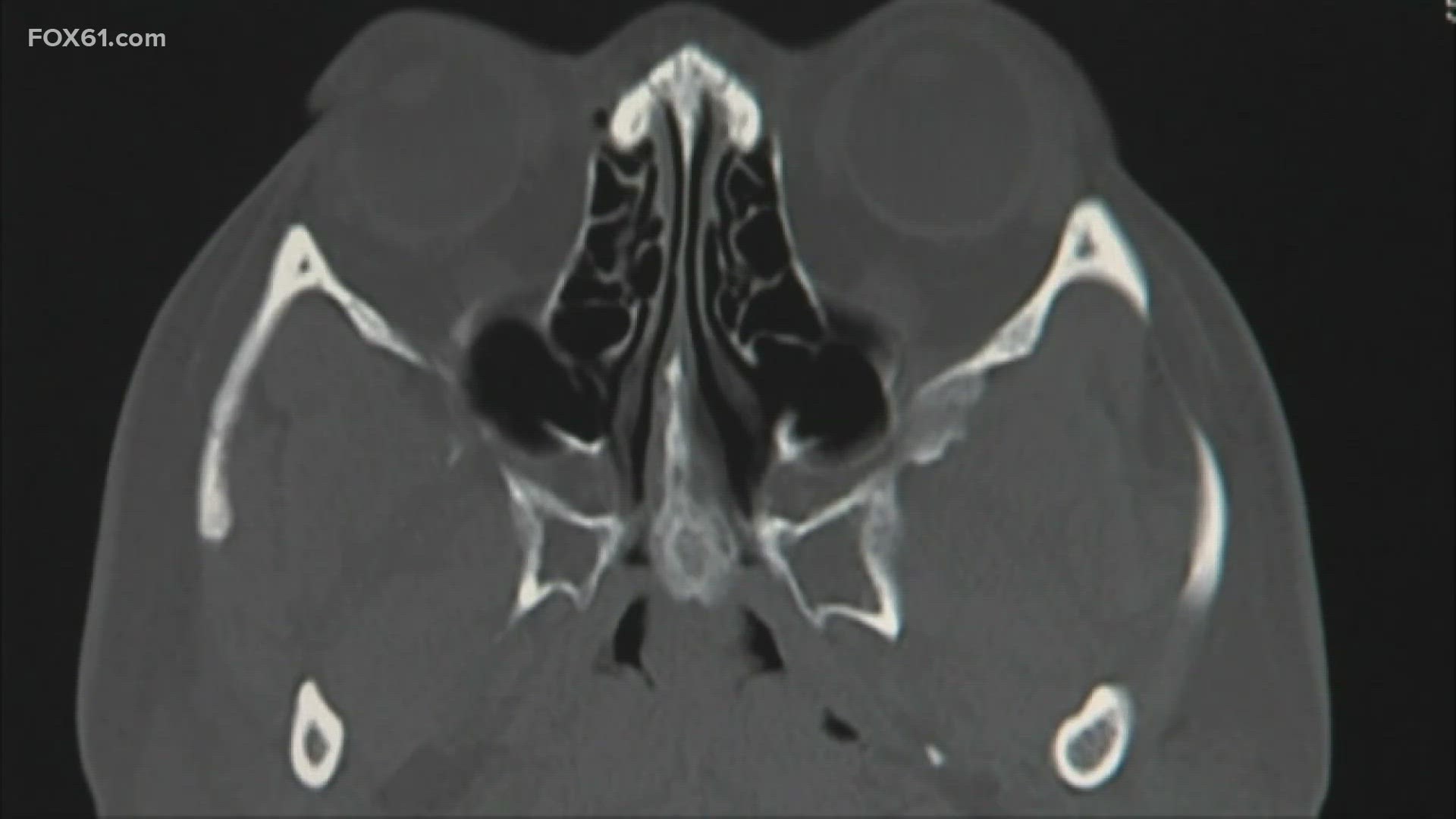 More women are getting diagnosed with CTE and WHO will announce aspartame update. Dr. Syed Hussain from Trinity Health of New England has the latest health news.