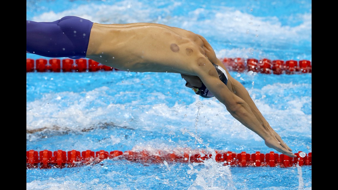 Olympics In Bright Red Spots: What Is Cupping? | Fox61.com