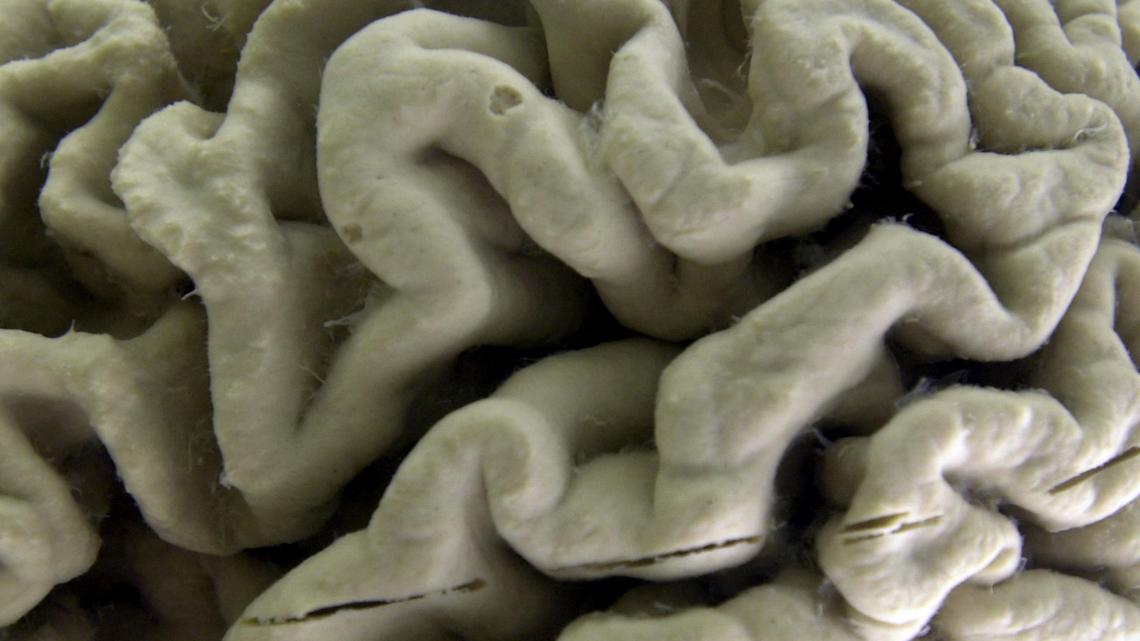 Connecticut releases new dementia care guide for Alzheimer's