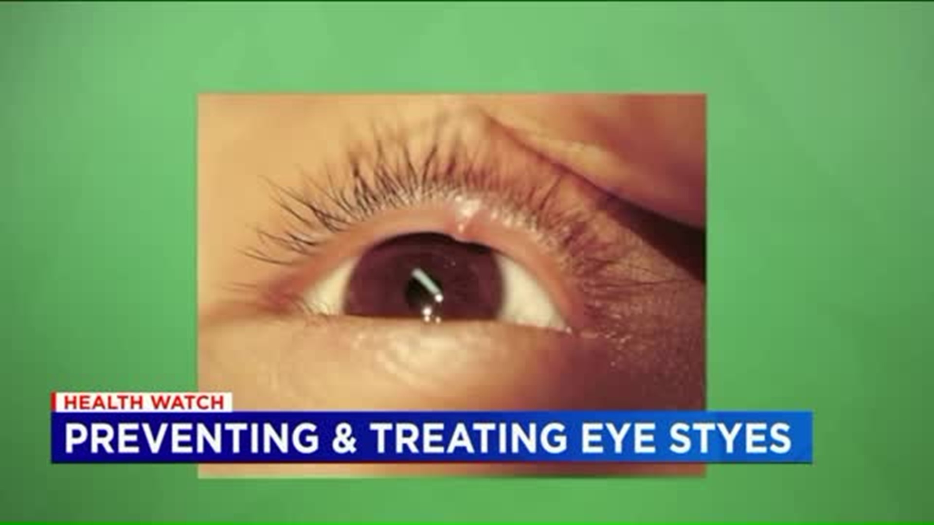 I Spy Eye Styes: How To Treat And Prevent A Nuisance | Fox61.com