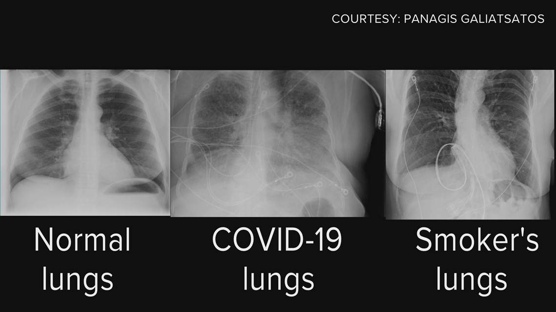 Covid Lungs Vs Smoking Lungs Long Term Effects Of Covid On Lungs 