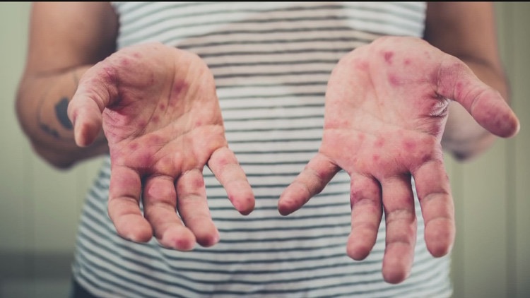 Case of measles reported in Fulton County, raising concerns of possible community exposure
