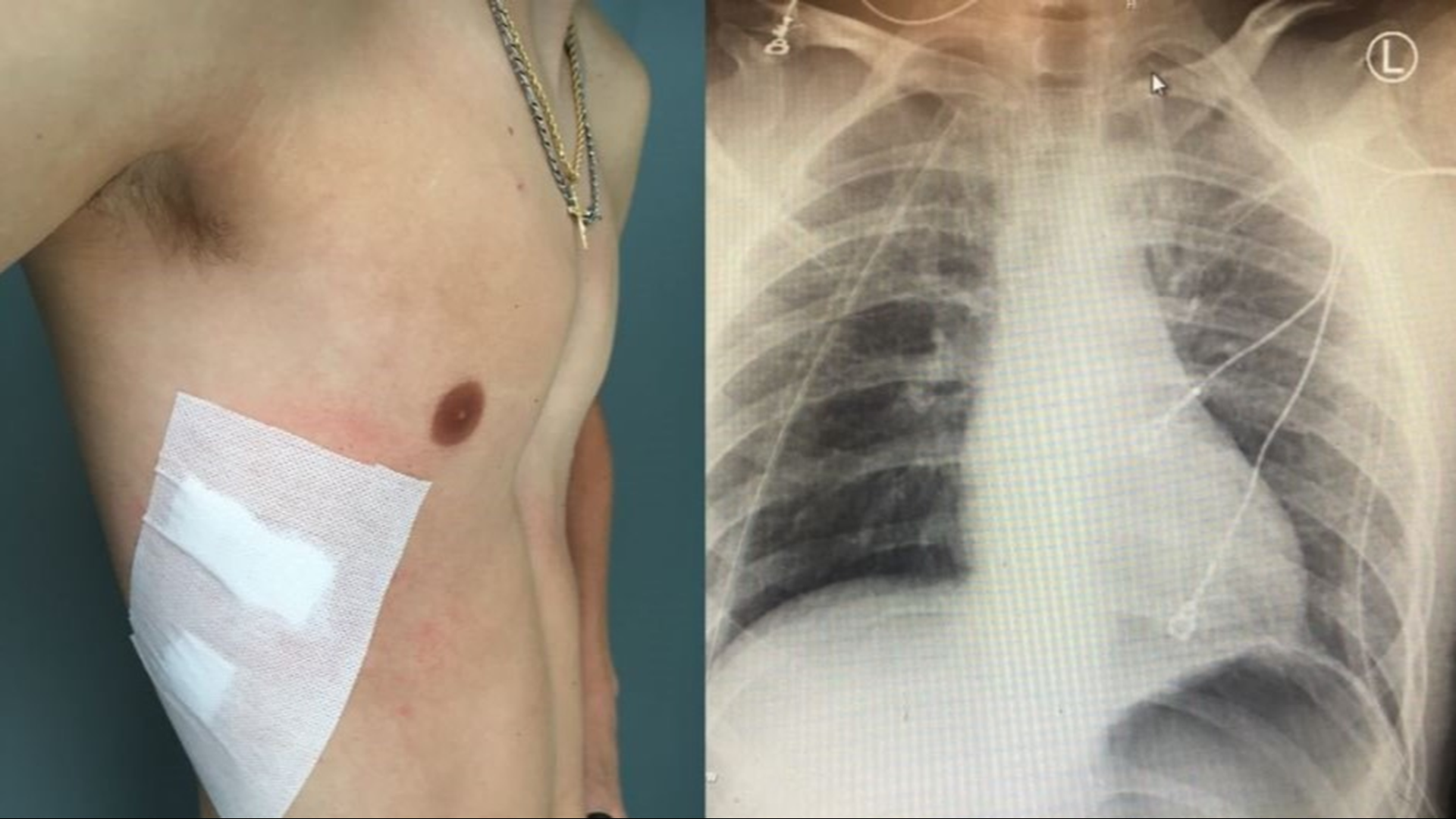 The 17-year-old hid his vaping for over a year, until he was rushed to the ER with a collapsed lung.
