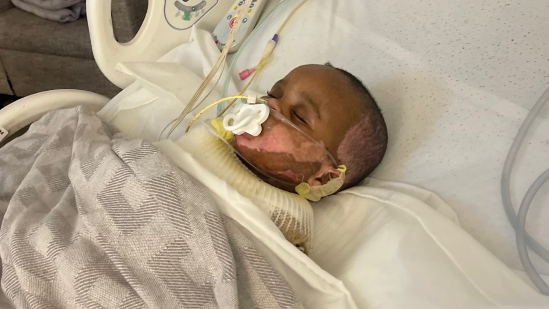 The 17-month-old from Powder Springs was taken off sedation but still has a tough recovery ahead at Augusta's pediatric burn unit.