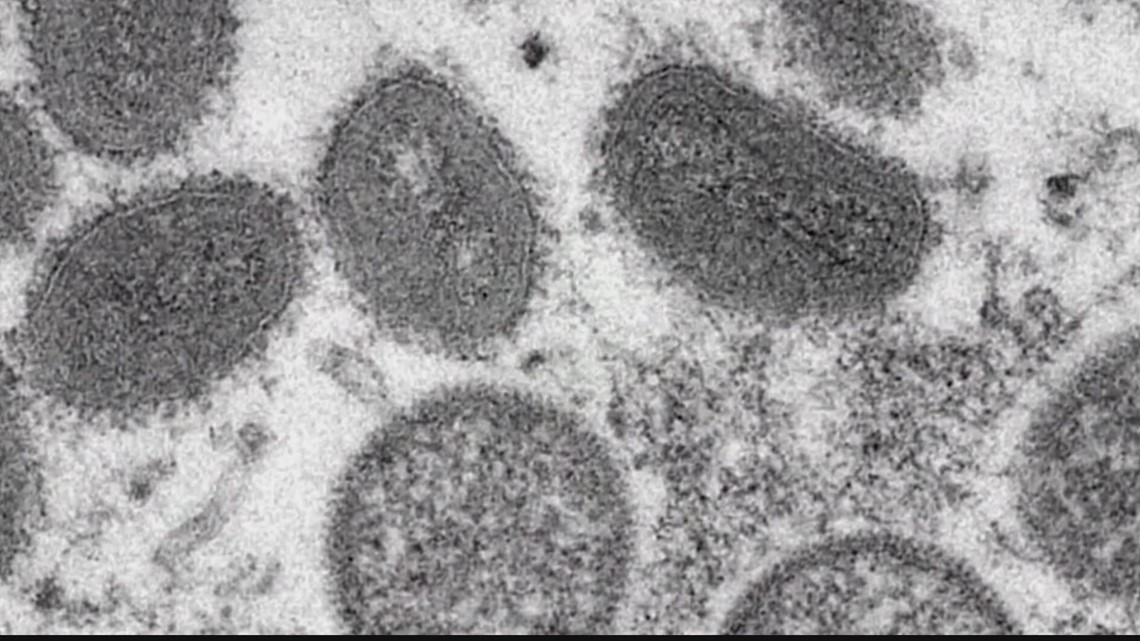 Monkeypox now a global emergency World Health Organization says - Vimarsana News