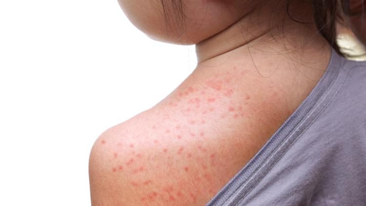 Three new measles cases reported in Georgia