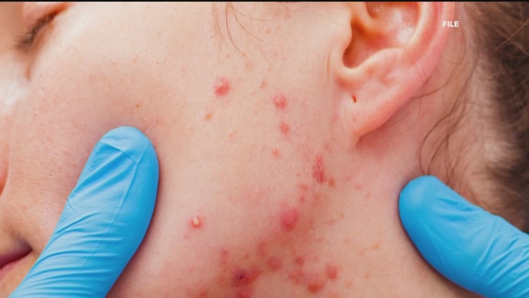 3 new measles cases in Georgia, all linked to Fulton County resident | What to know