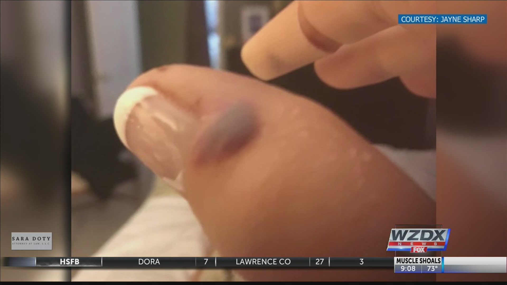 A Knoxville woman is still regaining feeling in her hands after multiple surgeries to stop a flesh-eating bacteria.