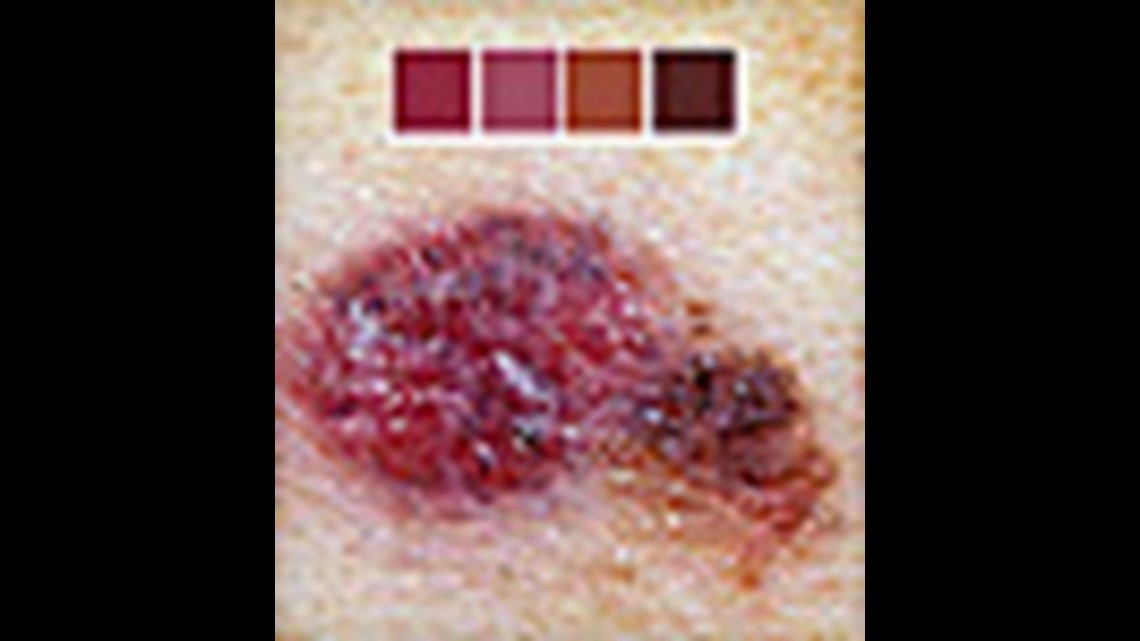 what-are-the-different-types-of-skin-cancer-and-how-do-you-tell-them