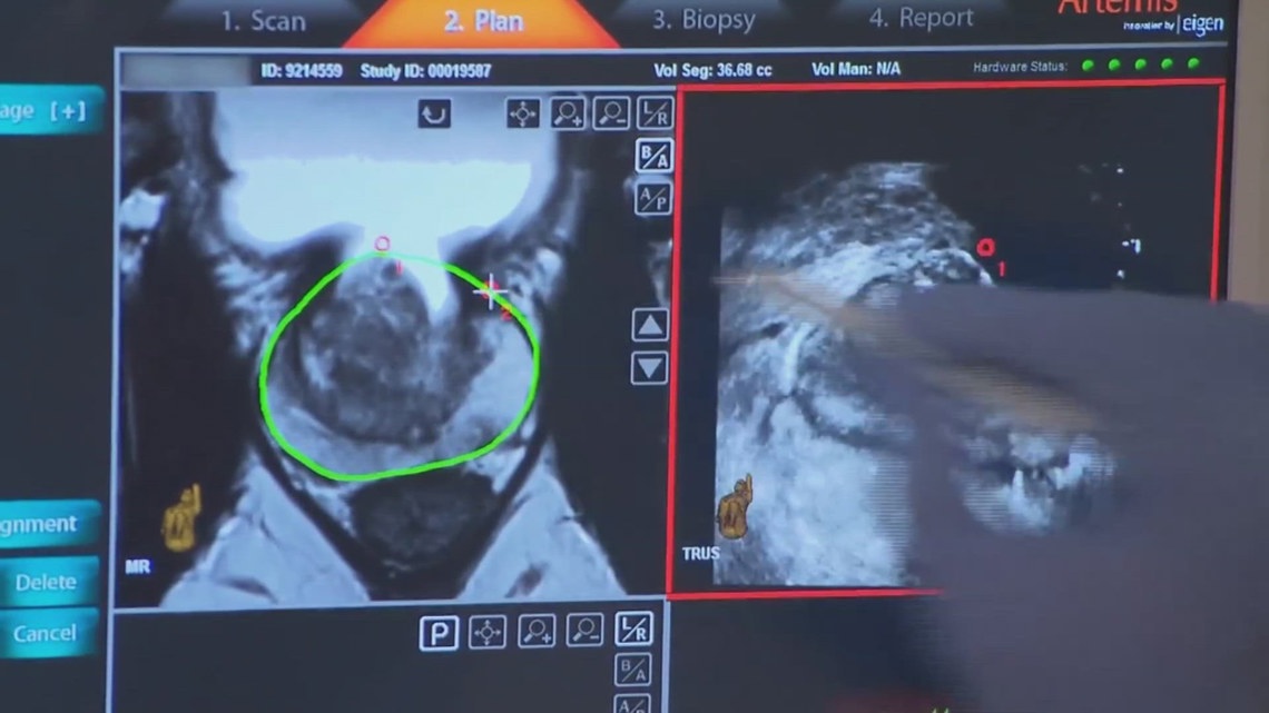 Alabama Senate committee OKs bill eliminating cost-sharing for prostate cancer screening