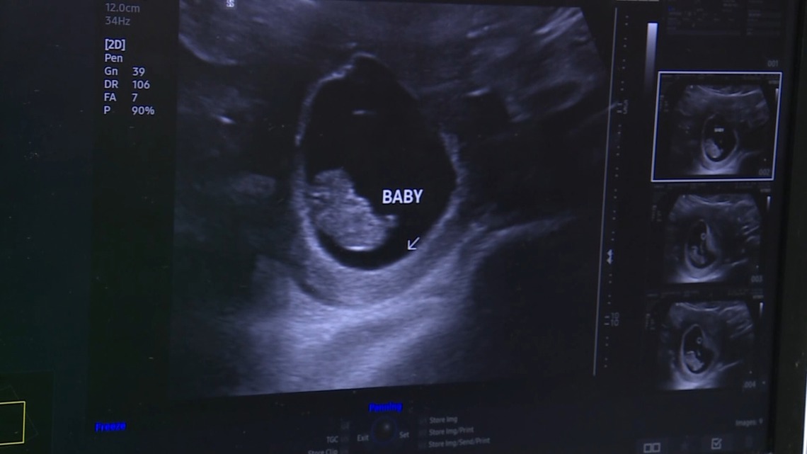 Alabama doctor criticizes robotic ultrasounds: 'Won't reduce maternal mortality'