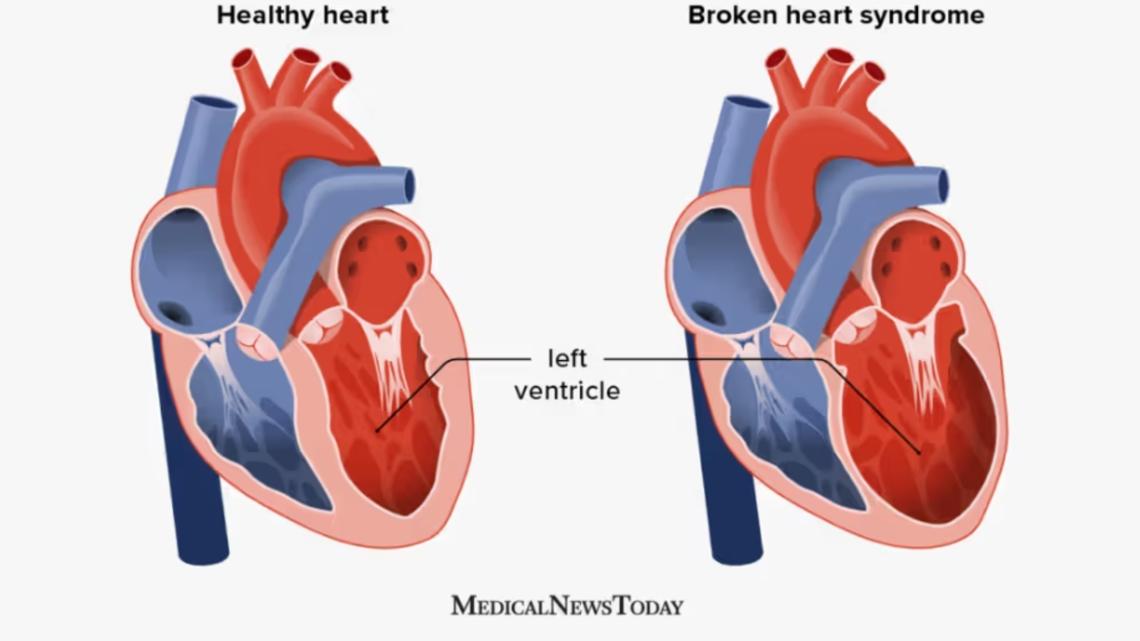 Wellness Wednesday | The science of sorrow: How a broken heart can physically change your heart shape