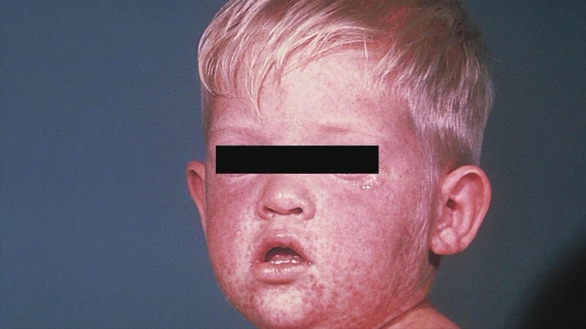 ADPH shares tips on identifying measles symptoms.