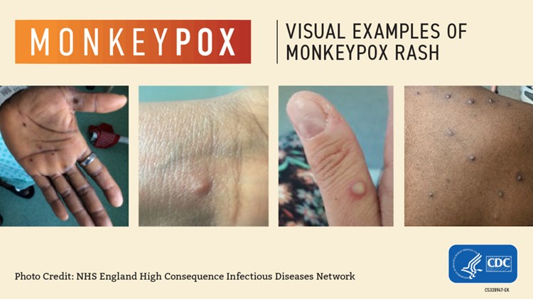 ADPH says Alabama seeing high number in Monkeypox infections