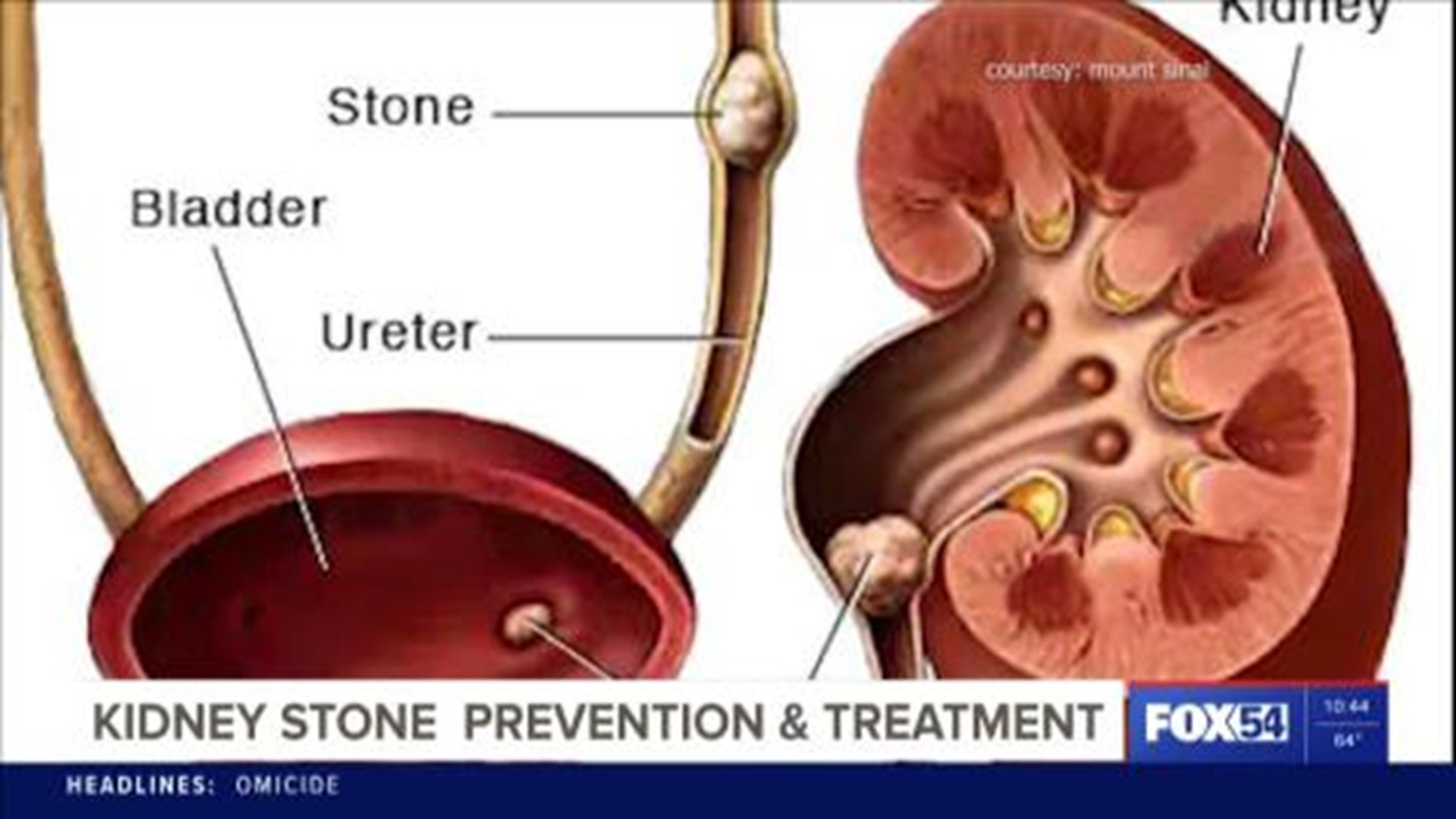 What you need to know about kidney stones and your health.