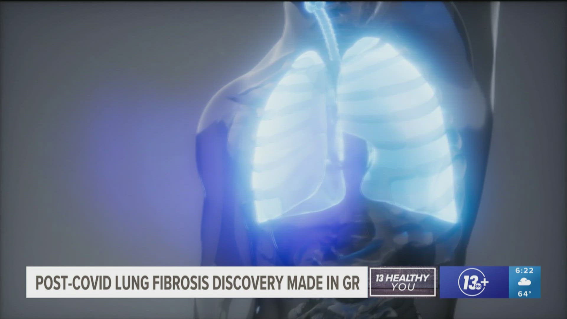 MSU researchers found a gene in excess for post-COVID patients with lung fibrosis. Nealy 10% of U.S. lung transplants are for post-COVID patients, according to UNOS.