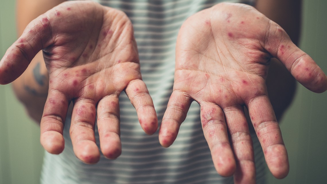 Health alert issued for Delaware County after reported outbreaks of hand, foot and mouth disease - 10TV